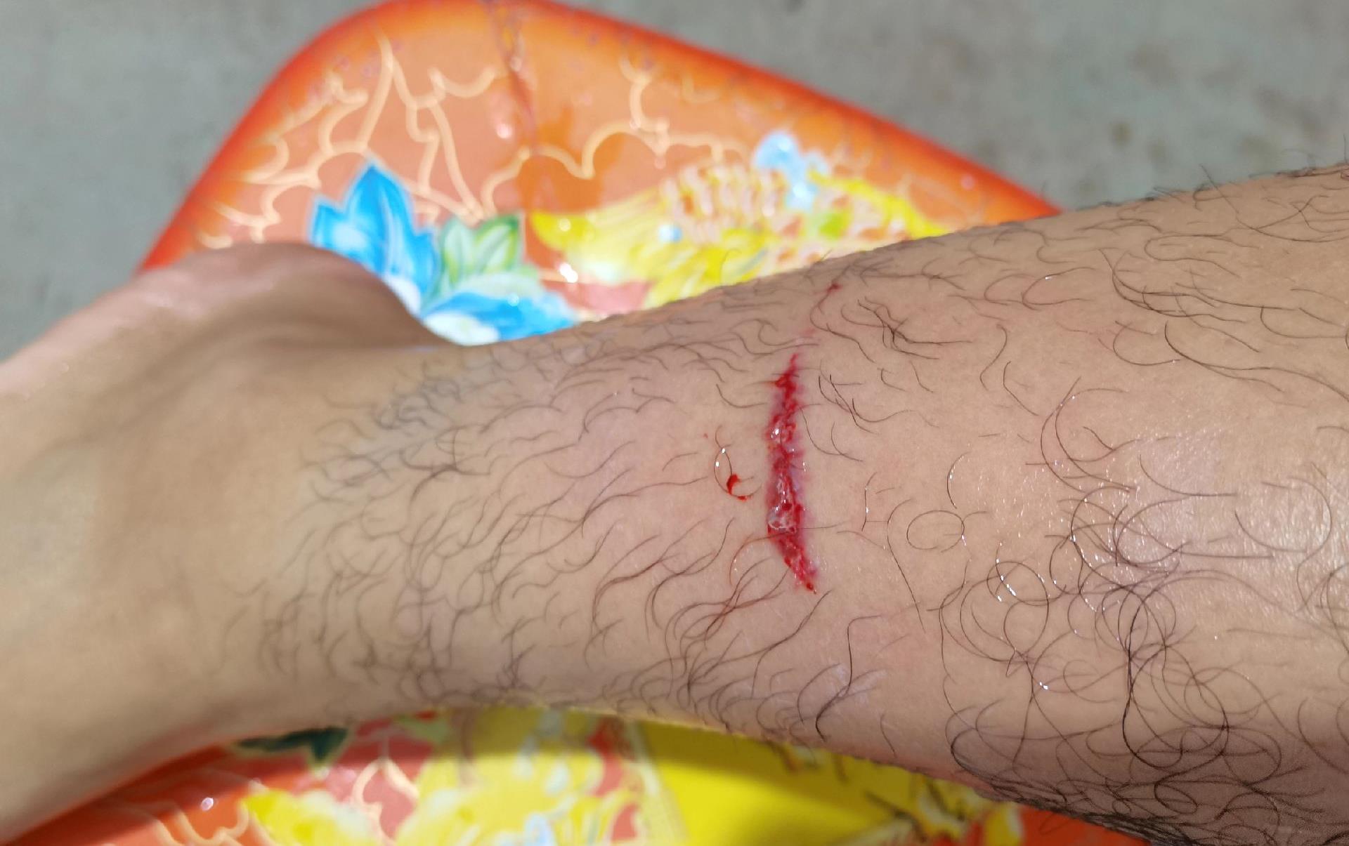 医生被狗咬了一口怎么办,被狗咬了医院没消毒直接打针