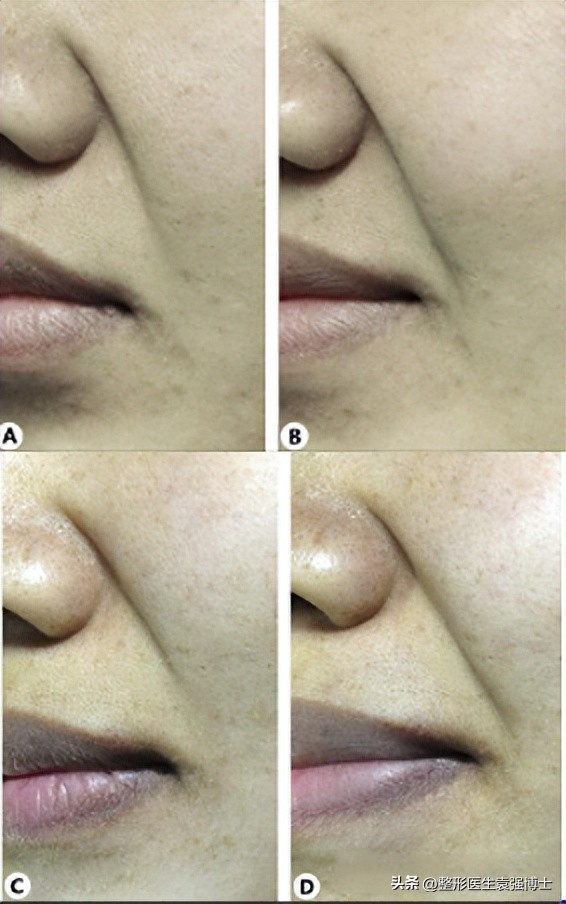 有法令纹千万不要做这三件事,年纪轻轻就有法令纹该怎样去解决