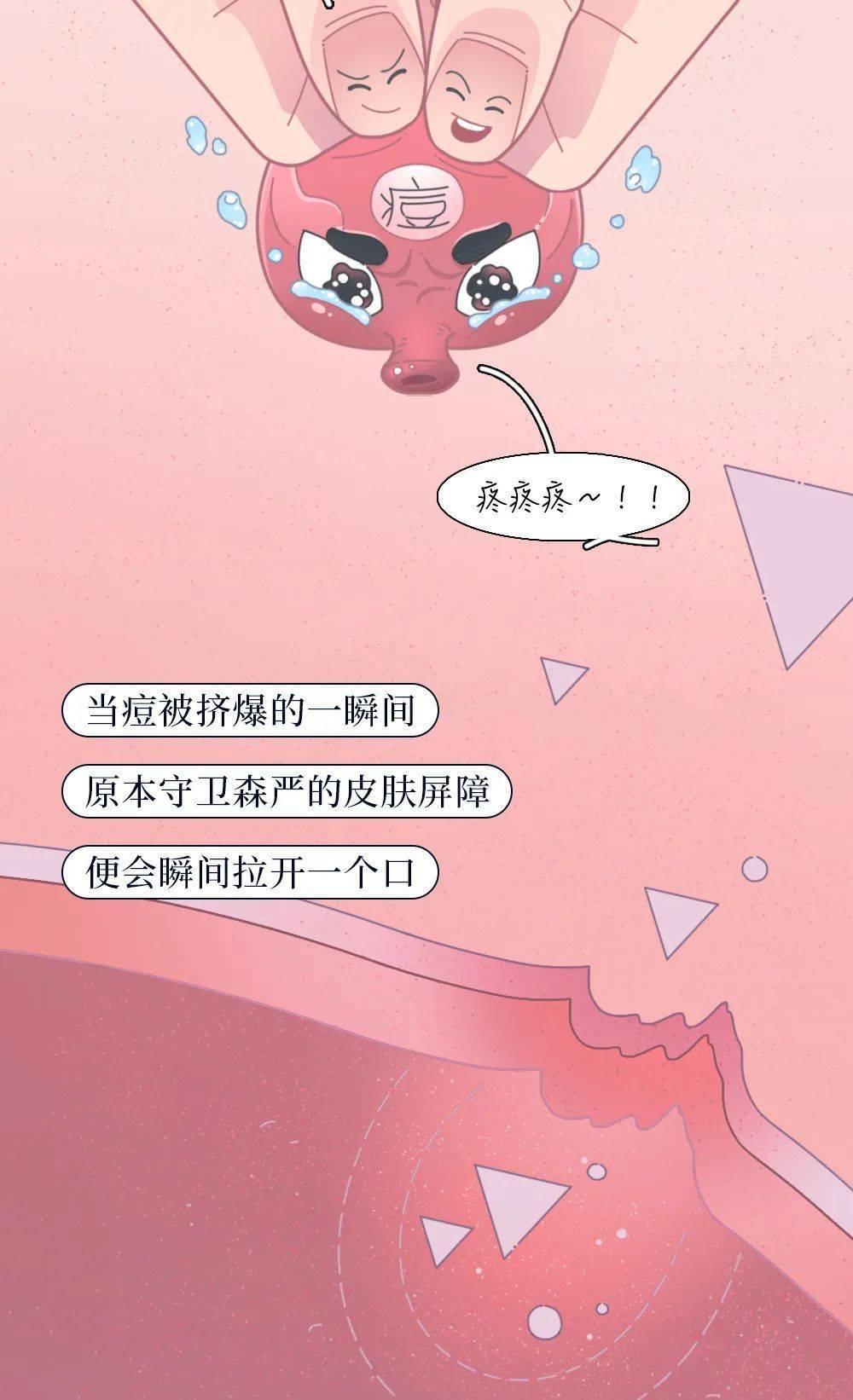 当青春痘挤爆,挤爆一个痘痘该咋办