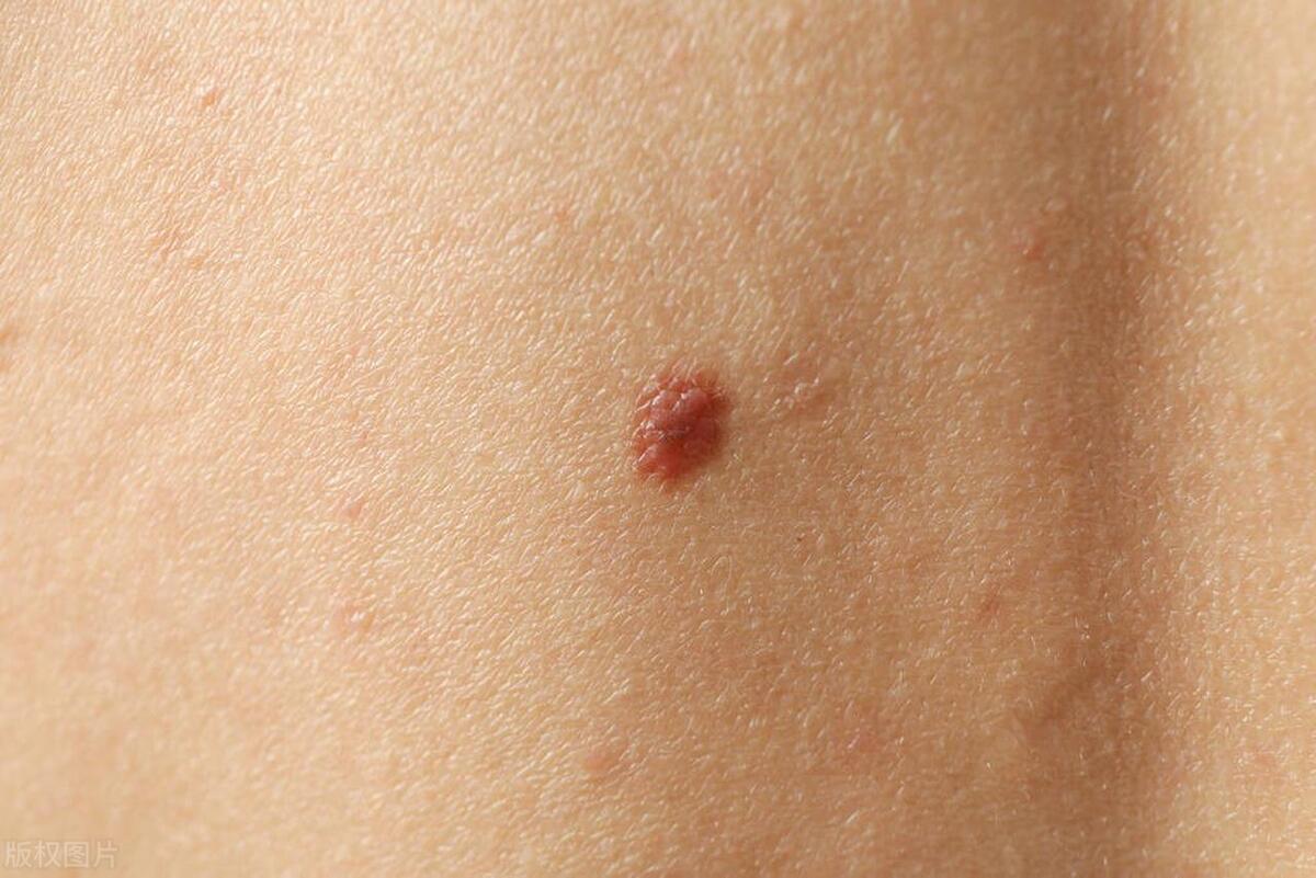 黑痣和黑色素瘤哪种易癌变,37岁歌手因为黑色素瘤去世