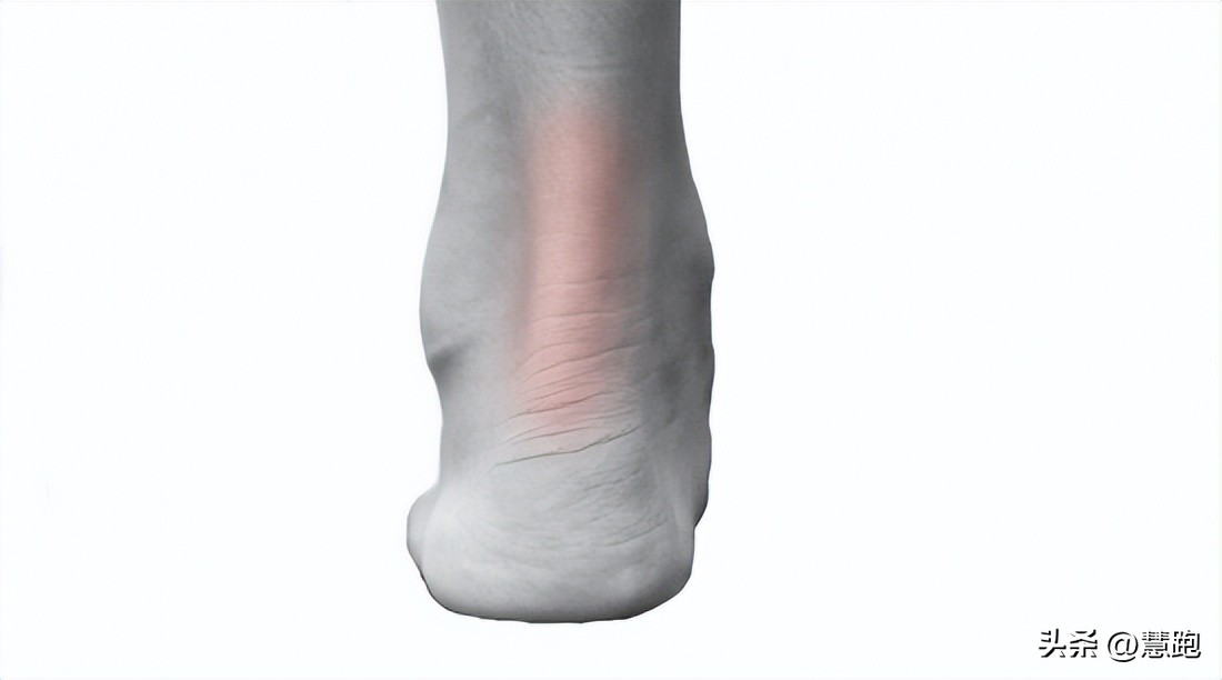 这类顽固性的跑步伤痛最让跑者头疼：4种有效康复方法教你破解