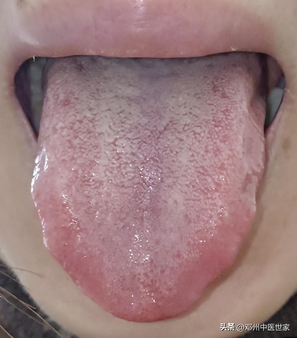 脸上长雀斑和晒斑要怎么内调,脸上长雀斑怎么内调