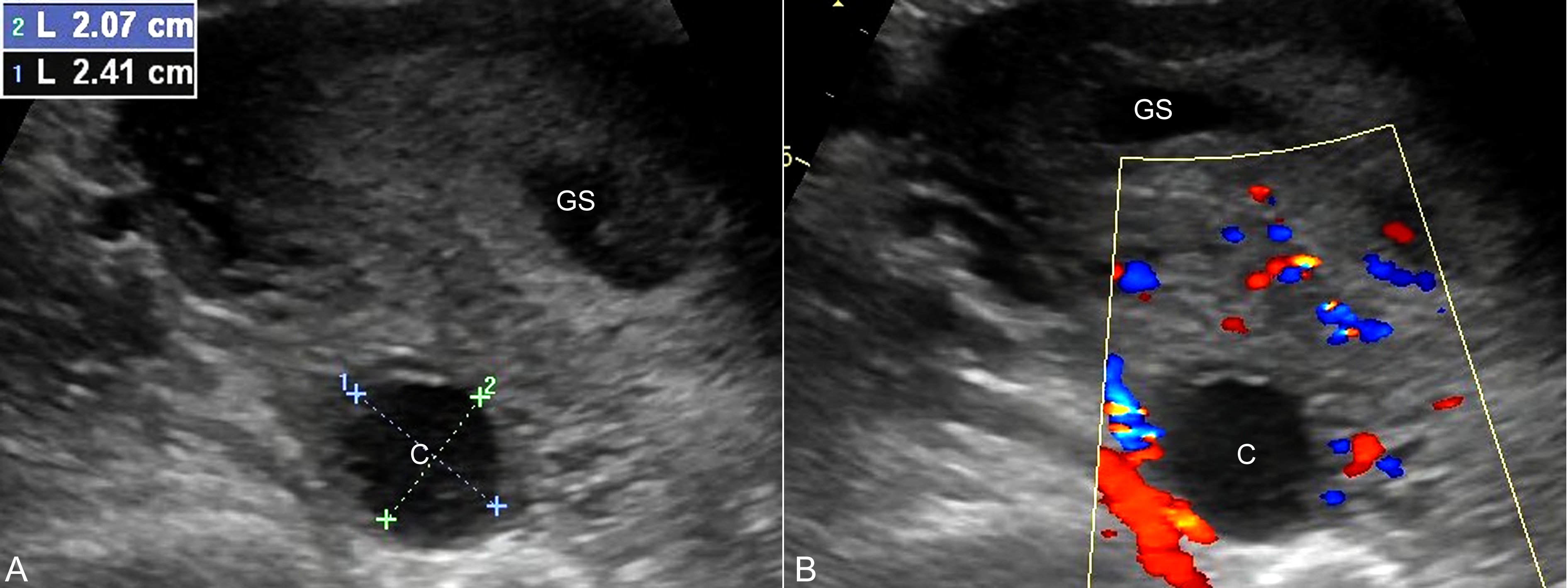怀孕时的黄体囊肿结节是什么,怀孕一个多月有黄体囊肿30x28mm