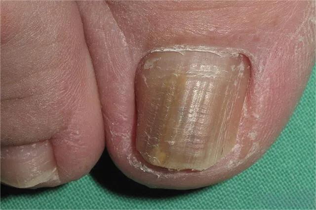 甲癣不严重怎么治疗,甲易生治疗灰指甲吗