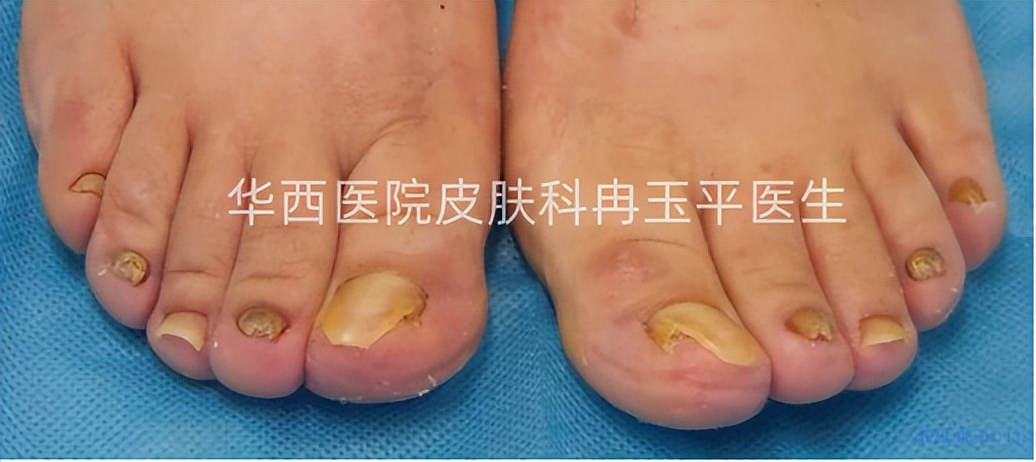 灰指甲是指甲发灰吗,指甲灰色就是灰指甲吗