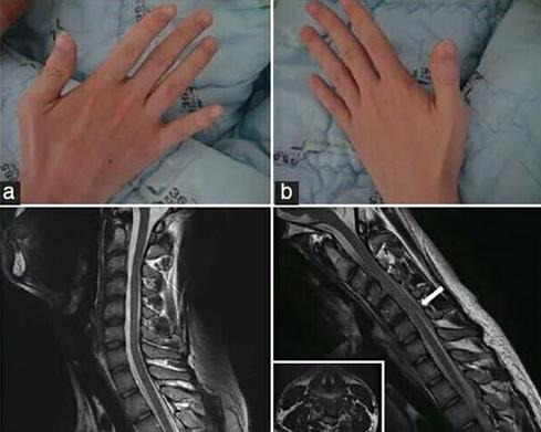 手萎缩无力是什么病,手腕无力手指笨拙虎口萎缩