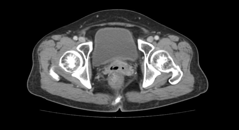 52岁宫颈癌患者在4年后出现肺部转移，但她并不悲观