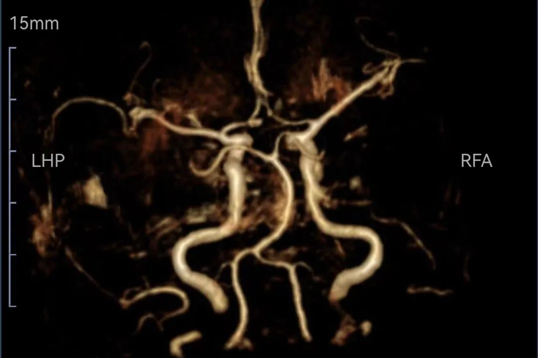 西安脑梗取栓康复医院,西安市第三医院脑卒中急救