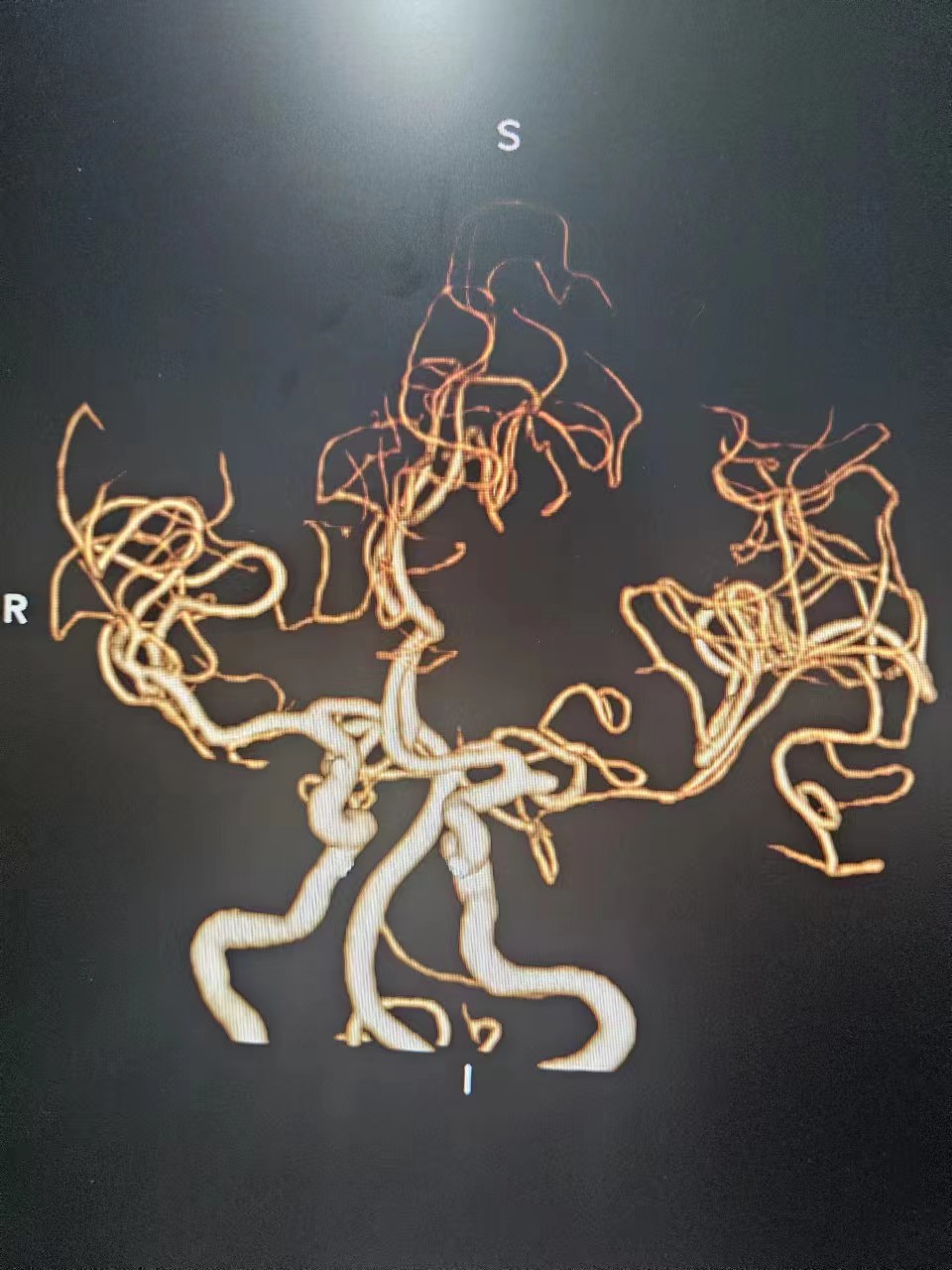 脑卒中血管取栓术,脑卒中动脉取栓