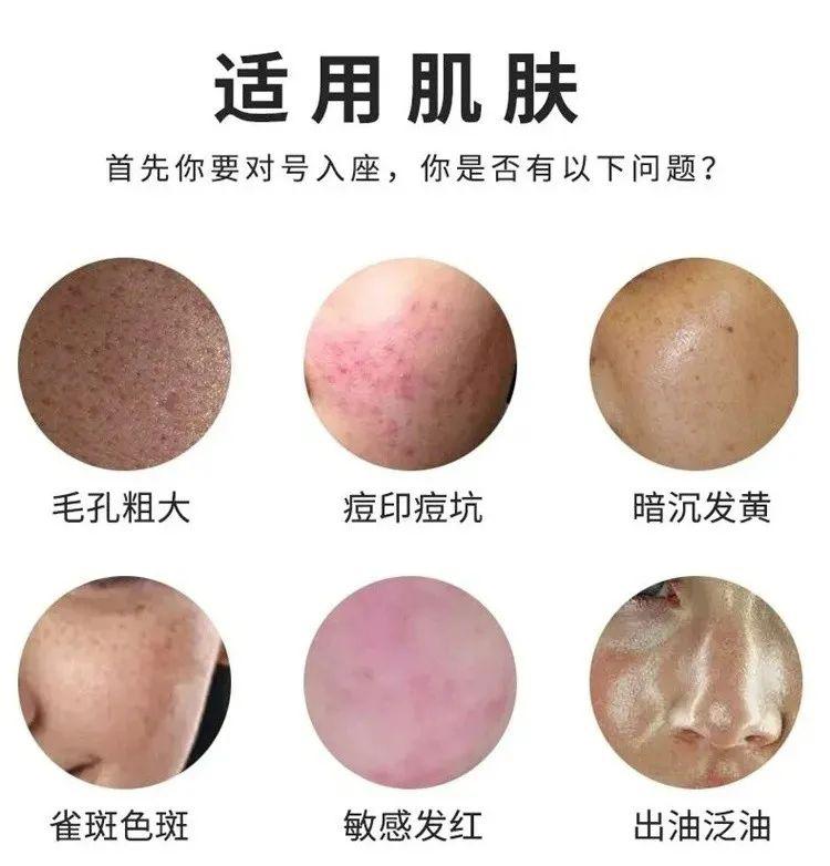 光子嫩肤济南市中心医院,济南光子嫩肤哪家医院最好