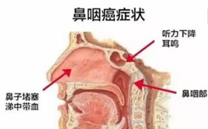 一侧鼻塞耳闷就一定是癌吗,鼻塞耳闷就是癌症吗