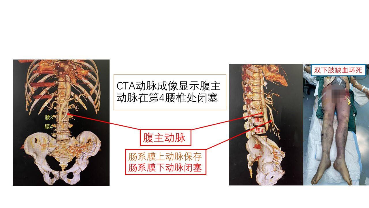 全球首例断头重生手术成功,世界首例成功的断肢再植手术