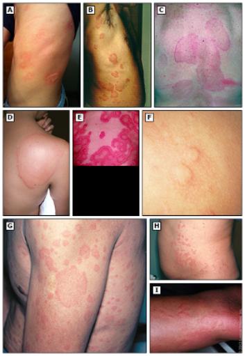 儿童生疹子哪里红点多,怎么区分孩子起的各种疹子