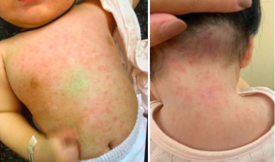 儿童生疹子哪里红点多,怎么区分孩子起的各种疹子