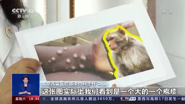 猴痘到底是种什么病？该如何预防？