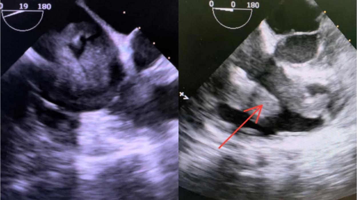 兰大二院心脏科,兰大二院心脏外科