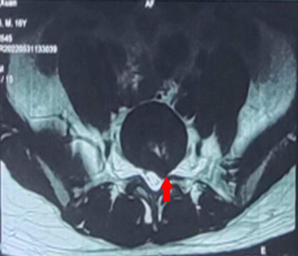 27岁摔成了腰椎间盘突出症,少年腰椎间盘突出怎么治疗