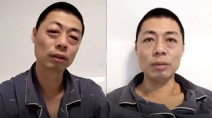 感染后头发变直了,感染后一夜白发