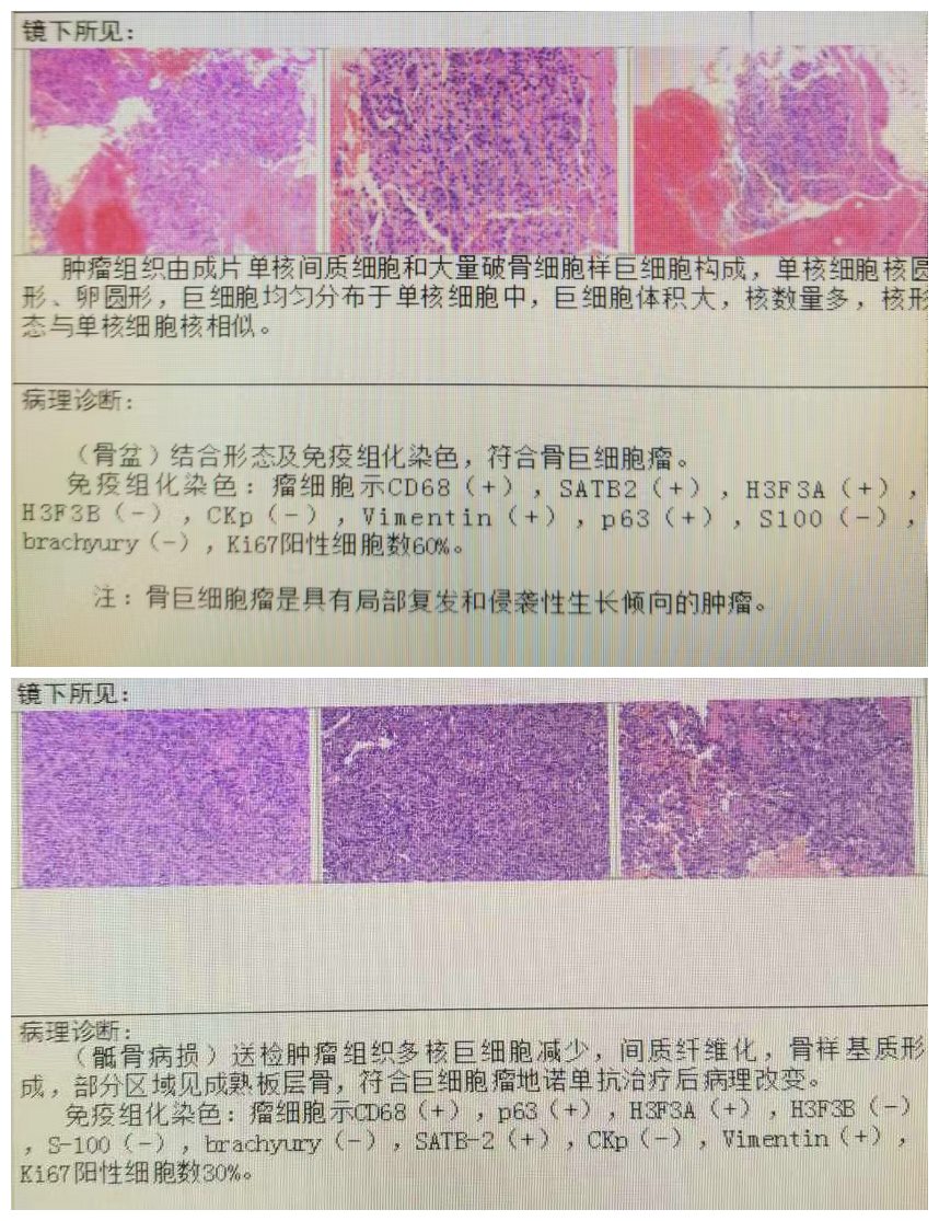 兰大二院腰椎间盘突出微创手术,兰大二院微创介入治疗