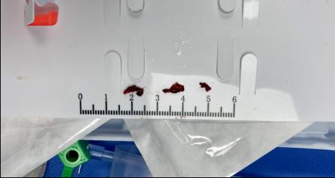脑卒中绿色通道急诊时间,急诊绿色通道卒中