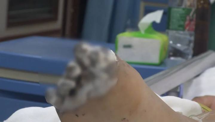 充电玩手机遭电击女孩面临截肢,玩苹果手机充电被电击面临截肢