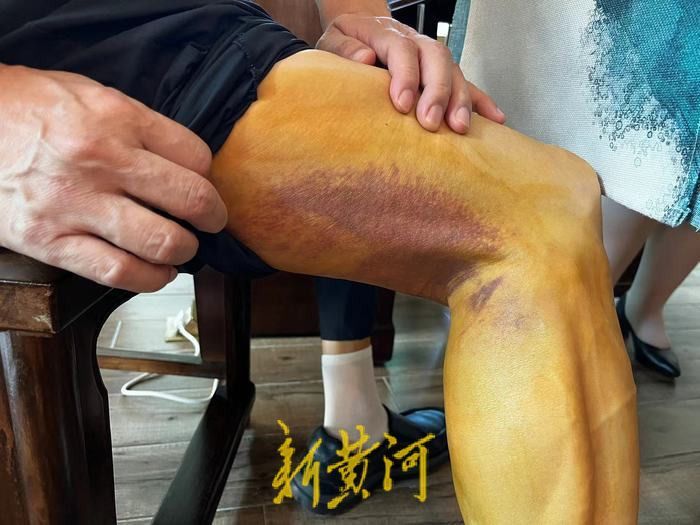 脚部瘀血10天还不消退怎么办,名医治疗双腿瘀血