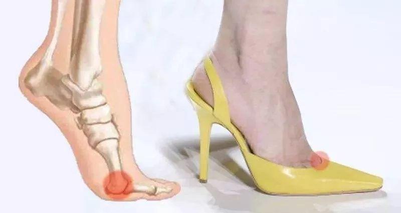 专家支招爱美女士，别让“水晶鞋”内的双脚受伤了