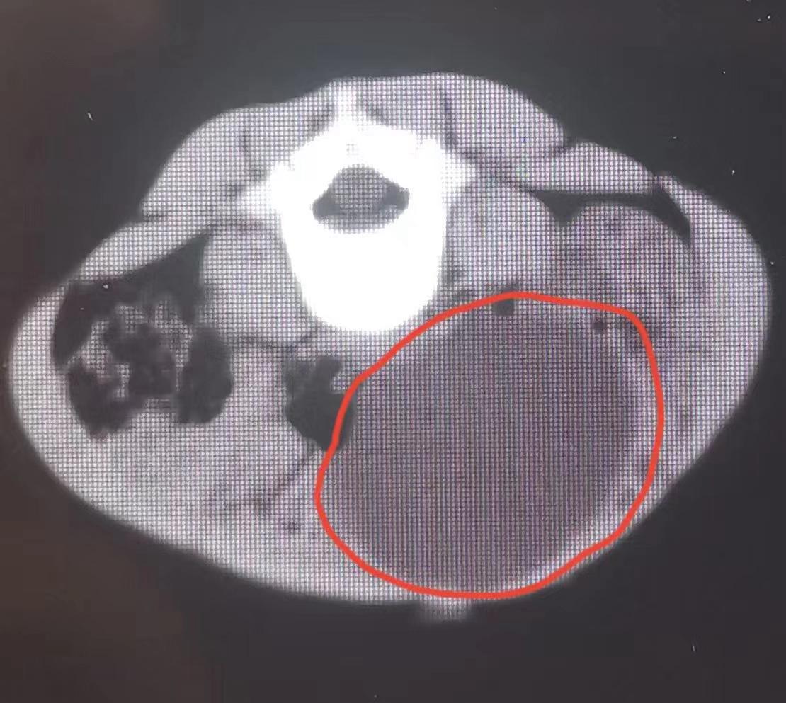 51岁女人腹部发现畸胎瘤,3岁女宝畸胎瘤总是肚子疼