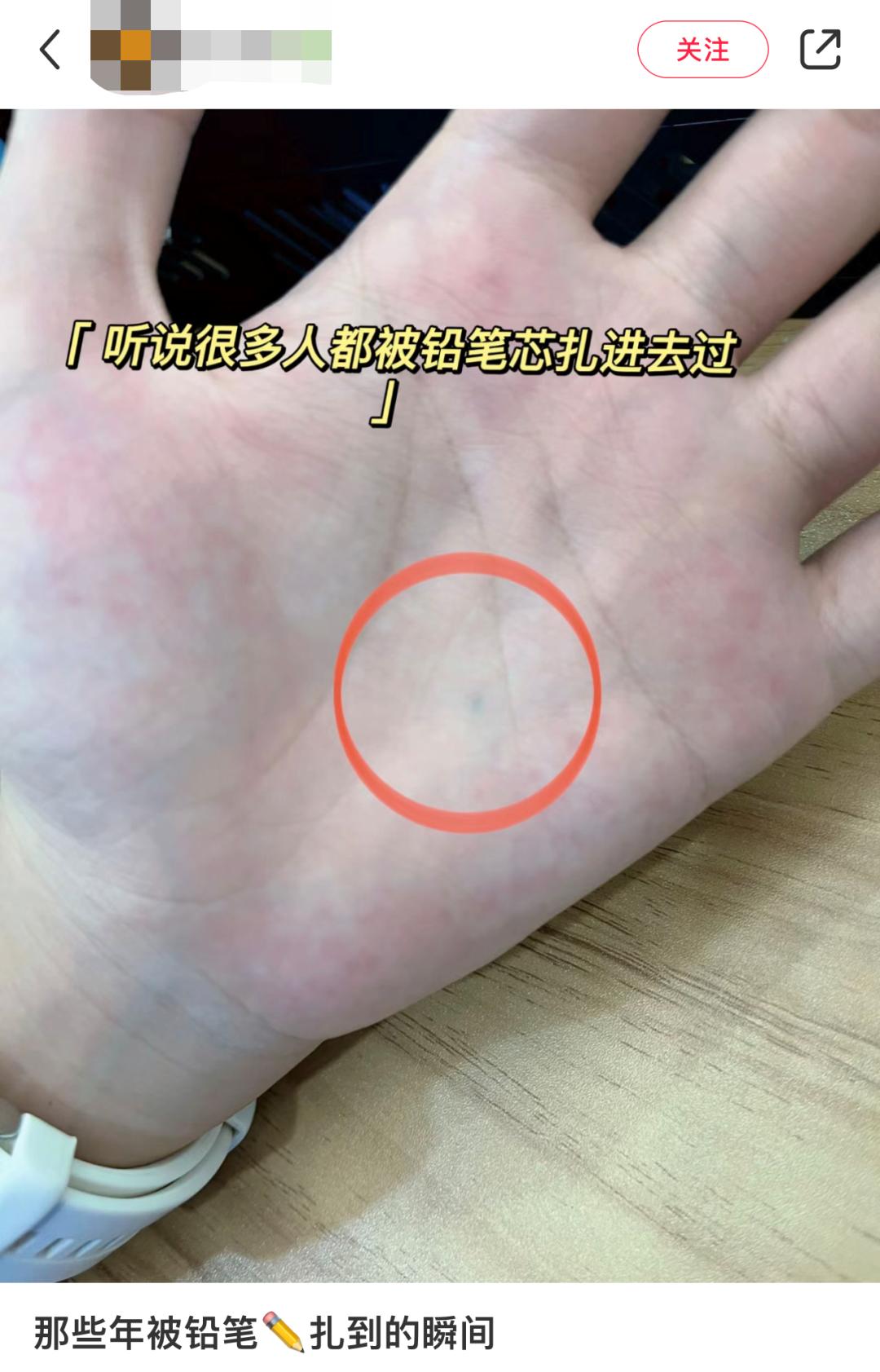 孩子被铅笔扎破了用打破伤风吗,孩子被铅笔扎伤最坏的结果是什么